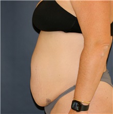 Tummy Tuck Before Photo by Steve Laverson, MD, FACS; Rancho Santa Fe, CA - Case 44656