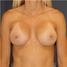 Breast Augmentation After Photo by Steve Laverson, MD, FACS; Rancho Santa Fe, CA - Case 44676