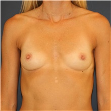 Breast Augmentation Before Photo by Steve Laverson, MD, FACS; San Diego, CA - Case 44676