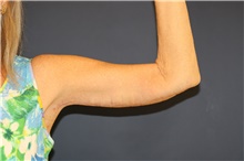 Arm Lift After Photo by Steve Laverson, MD, FACS; Rancho Santa Fe, CA - Case 44690