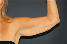 Arm Lift Before Photo by Steve Laverson, MD, FACS; Rancho Santa Fe, CA - Case 44690