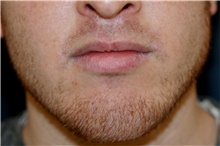 Lip Augmentation/Enhancement After Photo by Steve Laverson, MD, FACS; Rancho Santa Fe, CA - Case 44693