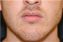 Lip Augmentation/Enhancement Before Photo by Steve Laverson, MD, FACS; Rancho Santa Fe, CA - Case 44693