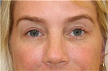 Eyelid Surgery After Photo by Steve Laverson, MD; San Diego, CA - Case 44697