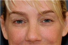 Eyelid Surgery Before Photo by Steve Laverson, MD; San Diego, CA - Case 44697