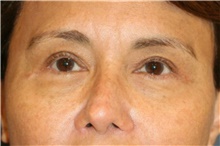 Eyelid Surgery After Photo by Steve Laverson, MD, FACS; Rancho Santa Fe, CA - Case 44706