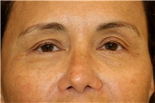 Eyelid Surgery Before Photo by Steve Laverson, MD, FACS; San Diego, CA - Case 44706