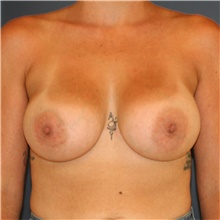 Breast Augmentation After Photo by Steve Laverson, MD, FACS; Rancho Santa Fe, CA - Case 44717