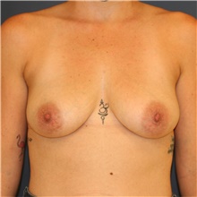 Breast Augmentation Before Photo by Steve Laverson, MD, FACS; Rancho Santa Fe, CA - Case 44717