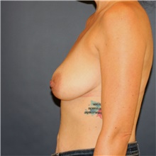 Breast Augmentation Before Photo by Steve Laverson, MD, FACS; Rancho Santa Fe, CA - Case 44717