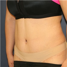 Tummy Tuck After Photo by Steve Laverson, MD, FACS; Rancho Santa Fe, CA - Case 44721