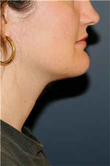 Chin Surgery After Photo by Steve Laverson, MD, FACS; San Diego, CA - Case 44727