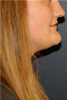 Chin Surgery Before Photo by Steve Laverson, MD, FACS; San Diego, CA - Case 44727