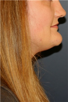 Chin Surgery Before Photo by Steve Laverson, MD, FACS; Rancho Santa Fe, CA - Case 44727