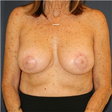 Breast Implant Revision After Photo by Steve Laverson, MD, FACS; Rancho Santa Fe, CA - Case 44729