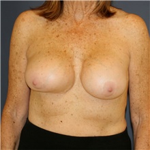 Breast Implant Revision Before Photo by Steve Laverson, MD, FACS; Rancho Santa Fe, CA - Case 44729