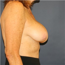 Breast Implant Revision Before Photo by Steve Laverson, MD, FACS; Rancho Santa Fe, CA - Case 44729