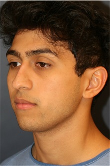 Rhinoplasty Before Photo by Steve Laverson, MD, FACS; Rancho Santa Fe, CA - Case 44735