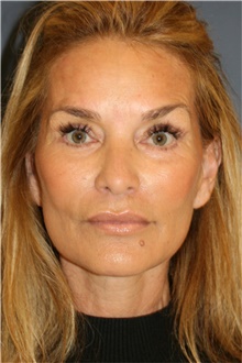 Facelift After Photo by Steve Laverson, MD, FACS; San Diego, CA - Case 44742