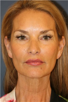 Facelift Before Photo by Steve Laverson, MD, FACS; Rancho Santa Fe, CA - Case 44742