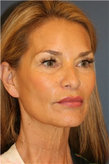 Facelift Before Photo by Steve Laverson, MD, FACS; San Diego, CA - Case 44742