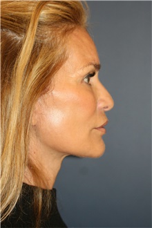 Facelift After Photo by Steve Laverson, MD, FACS; San Diego, CA - Case 44742