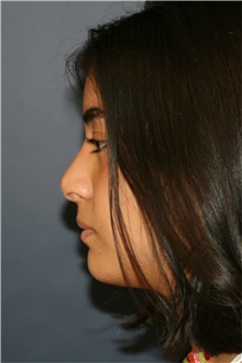 Rhinoplasty After Photo by Steve Laverson, MD, FACS; San Diego, CA - Case 44765