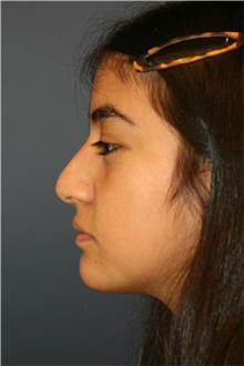 Rhinoplasty Before Photo by Steve Laverson, MD, FACS; Rancho Santa Fe, CA - Case 44765