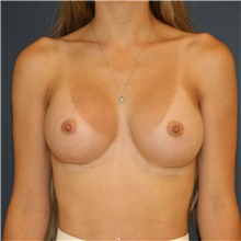 Breast Augmentation After Photo by Steve Laverson, MD, FACS; Rancho Santa Fe, CA - Case 44775