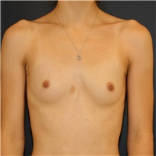 Breast Augmentation Before and After Photos