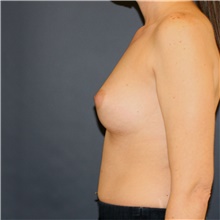 Breast Implant Revision Before Photo by Steve Laverson, MD, FACS; Rancho Santa Fe, CA - Case 44811