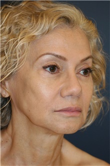 Rhinoplasty After Photo by Steve Laverson, MD, FACS; Rancho Santa Fe, CA - Case 44815