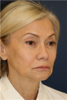 Rhinoplasty Before Photo by Steve Laverson, MD, FACS; Rancho Santa Fe, CA - Case 44815