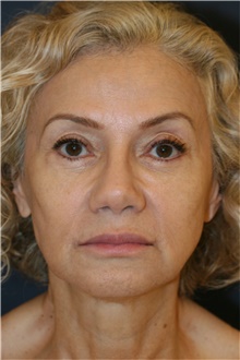 Rhinoplasty After Photo by Steve Laverson, MD, FACS; Rancho Santa Fe, CA - Case 44815