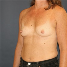 Breast Augmentation Before Photo by Steve Laverson, MD, FACS; Rancho Santa Fe, CA - Case 44931