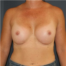 Breast Augmentation After Photo by Steve Laverson, MD, FACS; Rancho Santa Fe, CA - Case 44931