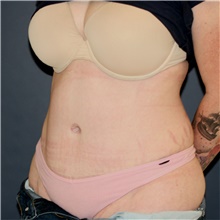 Tummy Tuck After Photo by Steve Laverson, MD, FACS; Rancho Santa Fe, CA - Case 44932