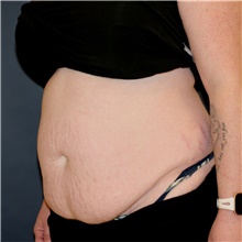 Tummy Tuck Before Photo by Steve Laverson, MD, FACS; Rancho Santa Fe, CA - Case 44932