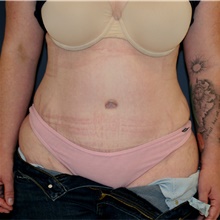 Tummy Tuck After Photo by Steve Laverson, MD, FACS; Rancho Santa Fe, CA - Case 44932