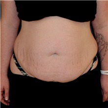 Tummy Tuck Before Photo by Steve Laverson, MD, FACS; Rancho Santa Fe, CA - Case 44932