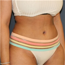 Tummy Tuck After Photo by Steve Laverson, MD, FACS; Rancho Santa Fe, CA - Case 44983