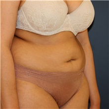 Tummy Tuck Before Photo by Steve Laverson, MD, FACS; Rancho Santa Fe, CA - Case 44983