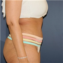 Tummy Tuck After Photo by Steve Laverson, MD, FACS; Rancho Santa Fe, CA - Case 44983