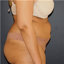 Tummy Tuck Before Photo by Steve Laverson, MD, FACS; Rancho Santa Fe, CA - Case 44983