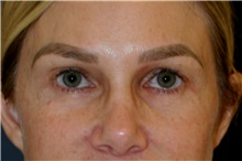 Eyelid Surgery After Photo by Steve Laverson, MD; San Diego, CA - Case 44985