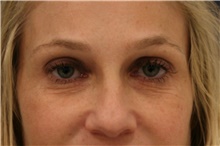 Eyelid Surgery Before Photo by Steve Laverson, MD; San Diego, CA - Case 44985