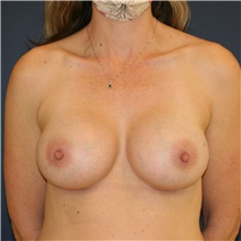 Breast Augmentation After Photo by Steve Laverson, MD, FACS; Rancho Santa Fe, CA - Case 45398