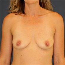Breast Augmentation Before Photo by Steve Laverson, MD, FACS; Rancho Santa Fe, CA - Case 45398