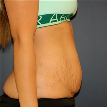 Tummy Tuck Before Photo by Steve Laverson, MD, FACS; Rancho Santa Fe, CA - Case 45403