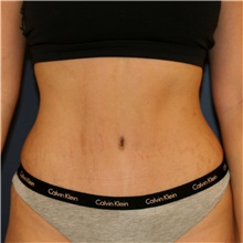 Tummy Tuck After Photo by Steve Laverson, MD, FACS; Rancho Santa Fe, CA - Case 45403